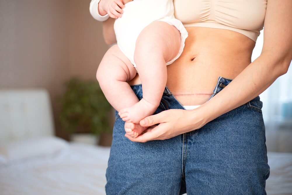 a young mother holds her baby while showing her cesarean scar