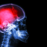 X-ray skull & cervical spine (lateral) with "Stroke"