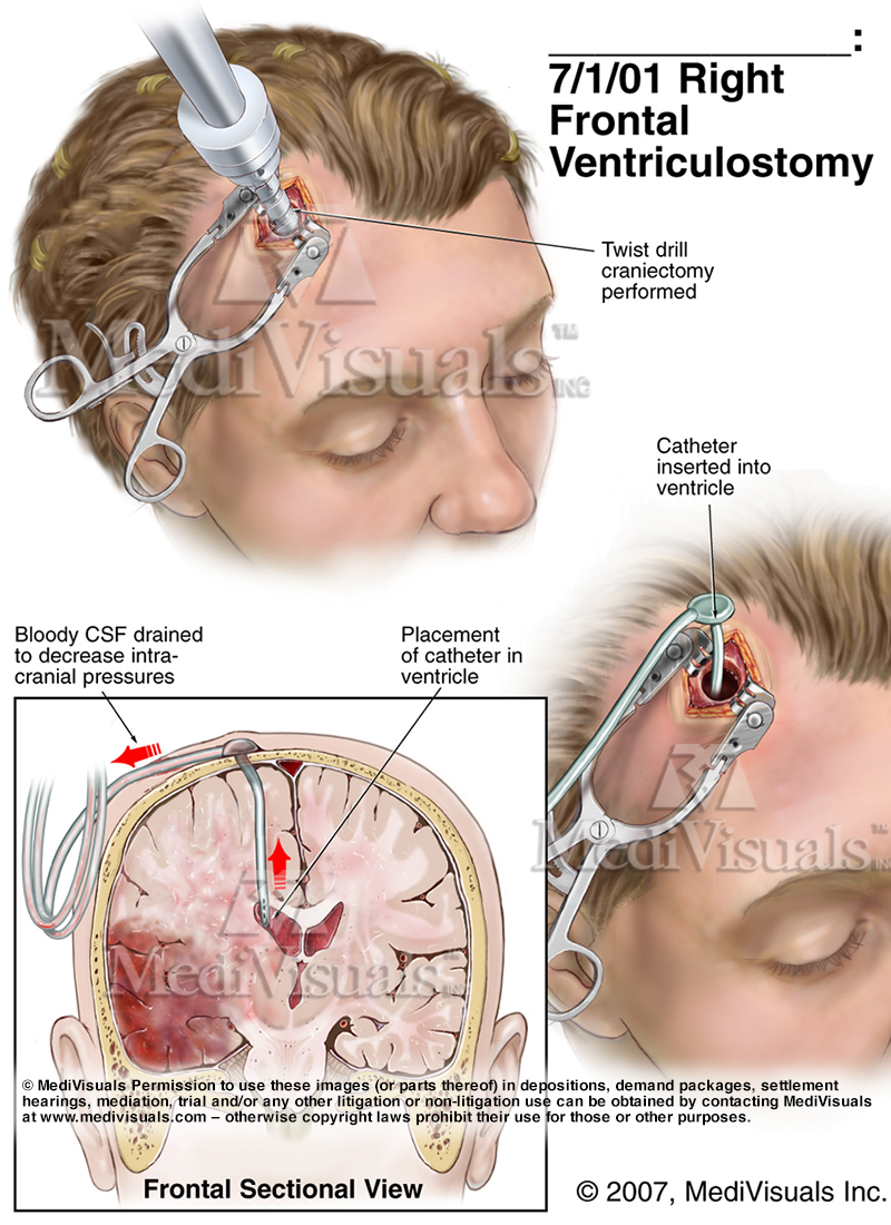 Understanding Traumatic Brain Injuries: Mild (less severe) to Severe ...