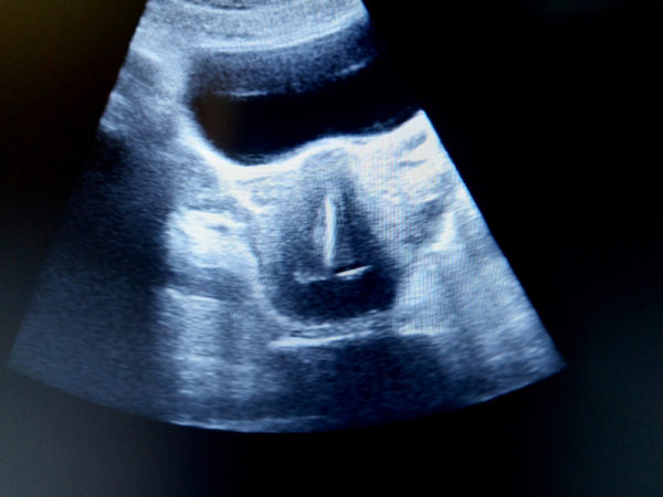 baby holding iud ultrasound